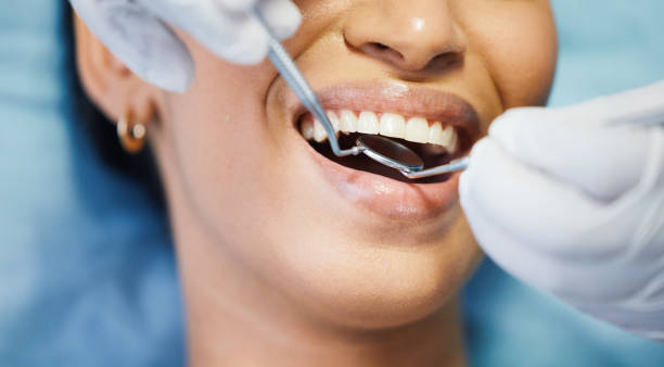 Emergency Dental Filling Replacement in NY